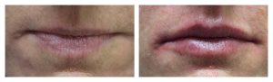 Lip Augmentation with HA filler
