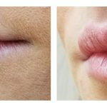 Lip Augmentation with HA filler