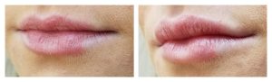 Lip Augmentation with HA filler