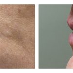 Lip Augmentation with HA filler