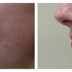Lip Augmentation with HA filler