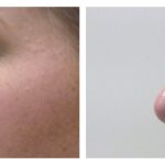 Liquid Rhinoplasty