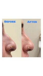 Liquid Rhinoplasty lifting the nasal tip and eliminating the dorsal hump