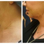 Submental liposuction