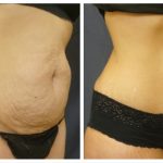 Abdominoplasty