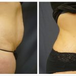 Abdominoplasty