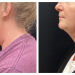 submental liposuction with Vaser and Renuvion