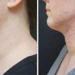 submental liposuction with Vaser and Renuvion