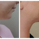 submental liposuction
