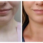 submental liposuction