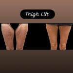 Thigh lift (Thigh Plasty)