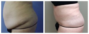 Abdominoplasty