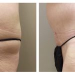 Abdominoplasty