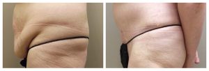 Abdominoplasty