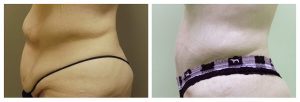 Abdominoplasty