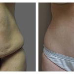 Abdominoplasty