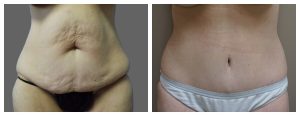 Abdominoplasty