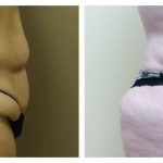 Abdominoplasty