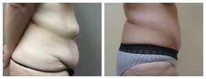 Abdominoplasty