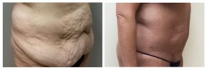 Abdominoplasty