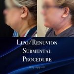 submental lipo with renuvion, Vaser, double chin