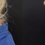 before after long flap face and neck lift with upper lip lift