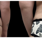 waist lipo post blurred tattoo