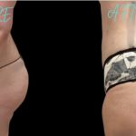 Vaser liposuction of the waist & abdomen with safe BBL using ultrasound