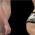 Vaser liposuction of the waist & abdomen with safe BBL using ultrasound