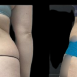 Vaser liposuction of the waist and back bra rol