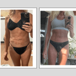 VASER liposhifting, fat grafting