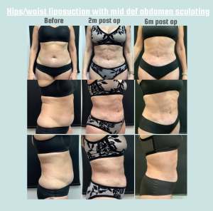 Abdominal liposculpting, progression of skin contraction